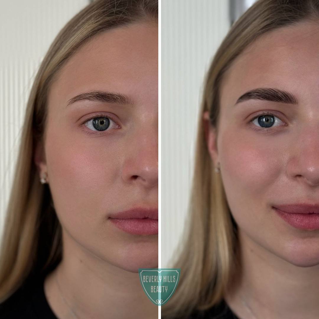 Brow Lifting in Wien
